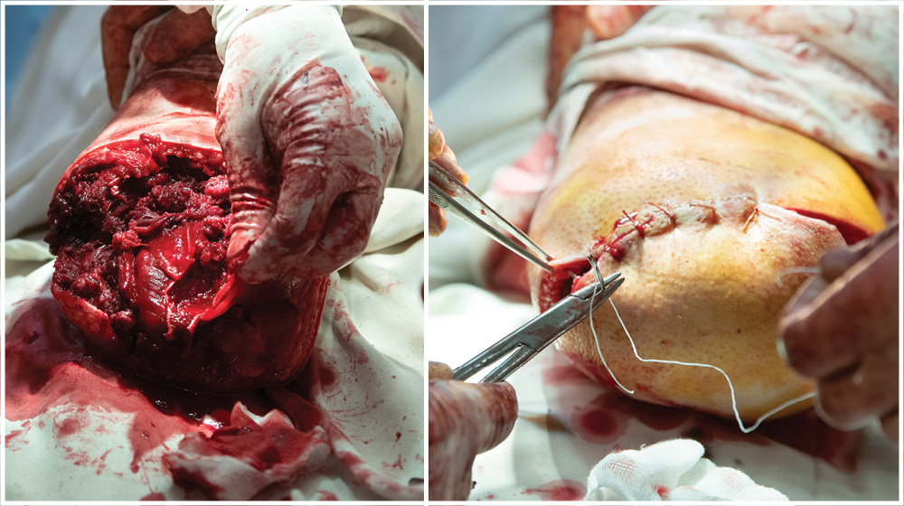 Two images, one of a surgical operation featuring the amputation of a leg on an operating table, and another surgeons sewing the skin around an amputated limb.