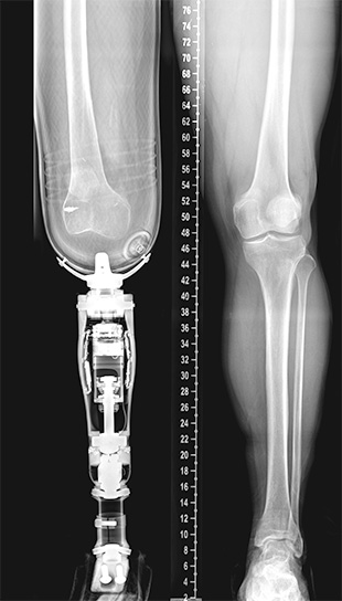 An xray of someone's legs, where one leg is amputated below the knee and connected to a prosthetic.